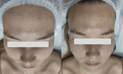 Уход-чистка Ultra-чистая кожа от  Ultraceuticals